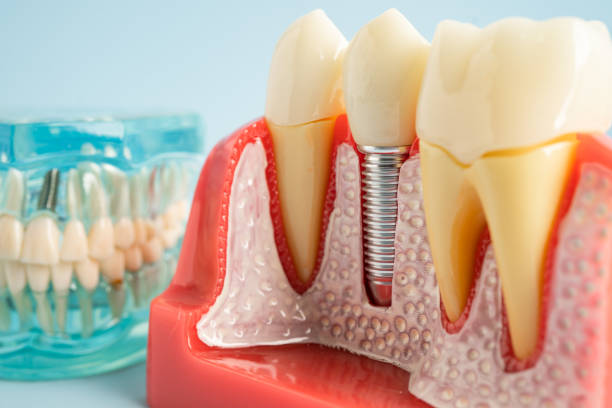 Best Tooth Extraction  in North Port, FL